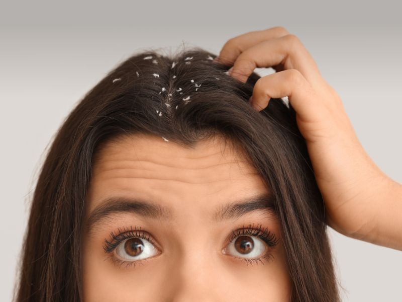 Young Woman with Dandruff Problem on White Background, Closeup